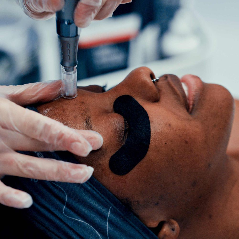 MICRONEEDLING